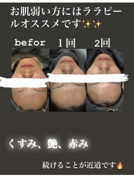 リツイート(ReTweet)/ララピール艶肌・美白・くすみ