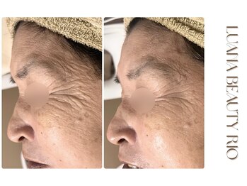 リオ(RIO)/初回で目元のシワがここまで変化