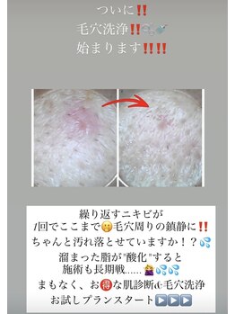 アローナ(ARONA)/毛穴洗浄スタート！