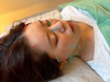 鍼灸・整体スマイルアップ 梅田院【整体/肩こり/腰痛肩こり/美容鍼/小顔美容鍼】の雰囲気（美容鍼/小顔施術もオススメ◎頭皮鍼/ヘッドスパで脳疲労改善も♪）