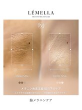 エルビービュティーサロン(LB BEAUTY SALON)/【ルメラ乳輪】実績数関西1★