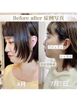 ルアナ(Luana)の写真/韓国美容【お肉溶解液をピストルで撃退】ク○ニック級をエステで!即効性◎ブルドッグフェイス、小顔に