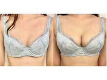 美人バスト 福岡店/バストアップ ◇症例◇