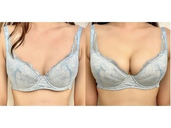 美人バスト 福岡店/バストアップ ◇症例◇