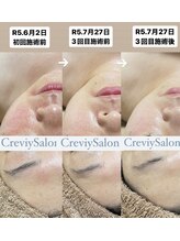 クレヴィー(Creviy)/陶肌トリートメント3回の変化