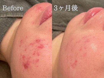 ポポラス(POPOLUS)/ニキビケア×プロテイン　3ヶ月