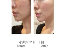 ミーシェ(Meshie)/口元のたるみケアもおまかせ♪