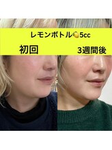 ララチッタ(L'la citta)/レモンボトル5cc