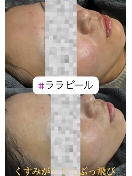 リツイート(ReTweet)/ララピール艶肌・美白・くすみ