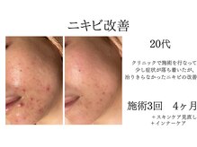 シャルナ(charna)の雰囲気(ニキビ、跡ケア 改善しない症状はありません)