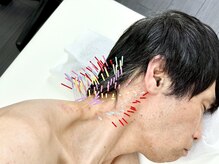 とだ鍼灸院/《鍼灸施術》寝起きの首痛対応◎
