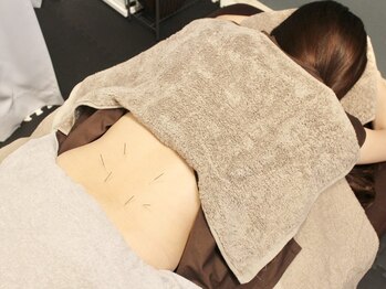 サボ 表参道 原宿(SABO)の写真/【腰痛は鍼で解消!?】座っても立っても辛い…そんな腰痛は鍼で改善！どこに行っても良くならなかった方に◎