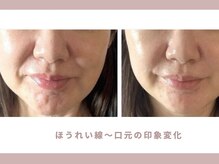 ロジワール(LOISIR)の雰囲気（小顔リフトアップ/小顔矯正/ほうれい線/むくみ/もたつき/）