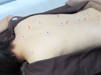 セレニテ(Serenite)/背中の施術（鍼・お灸）