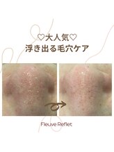フルーヴ ルフレ(Fleuve Reflet)/毛穴ケアでスッキリ★施術前/後