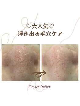 フルーヴ ルフレ(Fleuve Reflet)/毛穴ケアでスッキリ★施術前/後