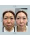 モア(eyelash salon MOOR)の写真/SNSで話題[クリニック監修]エクソリフト&プラズマで効果がよりパワーUP！年齢肌、深刻なニキビケアにも！