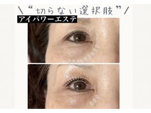 目元悩みを解決！千葉県初【アイパワーエステ】/東船橋駅/船橋