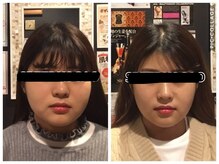 堺整骨院 小郡院/小顔矯正