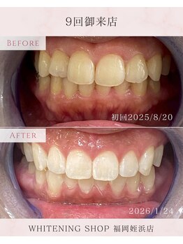 ホワイトニングショップ 福岡姪浜店/お客様before after