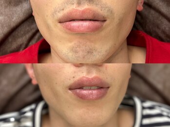 メンズ脱毛サロン ボス(BOSS)/【メンズ脱毛/ヒゲ脱毛】清潔感