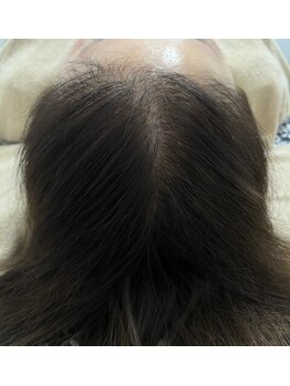 カブール 町田/頭頂部のボリュームアップにも!