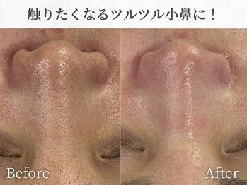 芯美 恵比寿店(shinbi)/触りたくなるツルツル小鼻に！