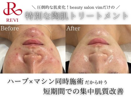フェイシャルヴィム(FACIAL VIM)の写真