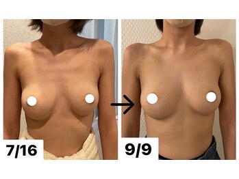 プレフィール(PLEAFEEL)/バストケア◇症例◇たまプラーザ