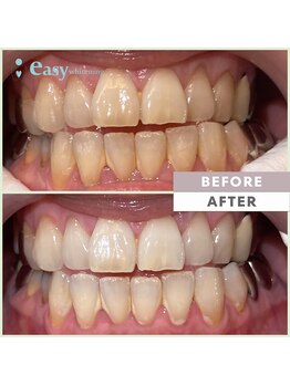 イージーホワイトニング 中野店(easy whitening)/セルフホワイトニング症例写真
