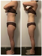 ベルミナ(Belmina)/大名/天神/毛穴/脱毛/痩身