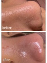 ニコ(nico)/毛穴/皮脂詰まり/角栓/ザラつき