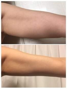 ラグラン銀座メディカルエステ 高輪ゲートウェイ店/セルマジ温活吸引をブライダルに