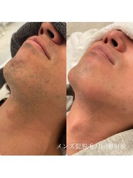 エクラ(eclat)/メンズひげ脱毛