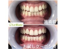 ルブラン 奈良店(Le Blanc)/歯が白くなると。。。