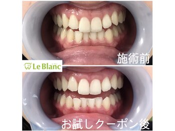 ルブラン 奈良店(Le Blanc)/歯が白くなると。。。