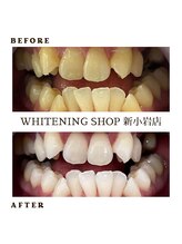 ホワイトニングショップ 新小岩店/ホワイトニングBeforeAfter