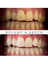 ユーラボ 表参道(YOU-LAB)/Befor/After【ホワイトニング】