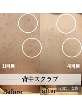 パルティノ 高崎店/背中スクラブ