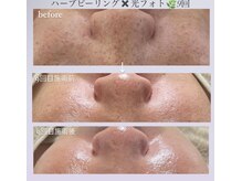 クレヴィー(Creviy)/ハーブ×ホームケア×IPLフォト