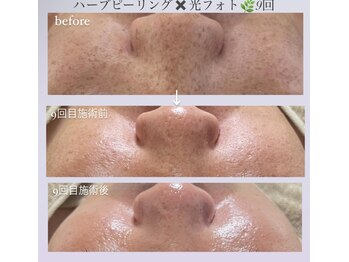 クレヴィー(Creviy)/ハーブ×ホームケア×IPLフォト