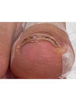 爪の悩みを解消できる（ケア含む）