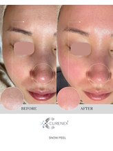 トータルクリア(TOTAL CLEAR)/雪花ピール大人気！