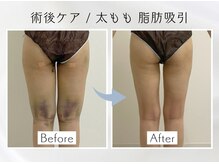 アピ(api)の雰囲気（術後ケアの得意なサロン。少ないインディバ回数でも効果を実感。）
