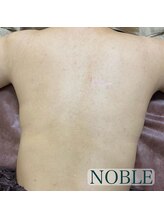 ノーブル 新宿南口(NOBLE)/背中リベルハーブピーリング
