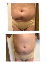 長寿鍼灸院 長寿整骨院/EMS＜お腹集中コース＞