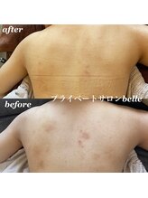 ベル(belle)/背中ハーブピーリング１回