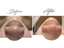 ビズビズ 天王寺店(bisebise)/〈症例〉毛穴詰まり.黒ずみ開き