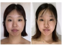 真美(Sinbi)/リターン小顔五回コース終了★