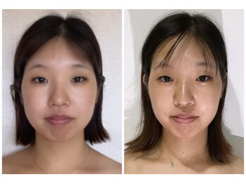 真美(Sinbi)/リターン小顔五回コース終了★